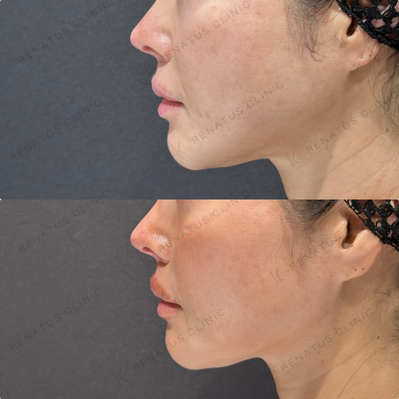 頬ヒアルロン酸ボライト症例写真