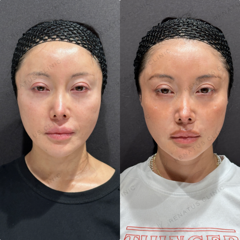 頬ヒアルロン酸ボライト症例写真