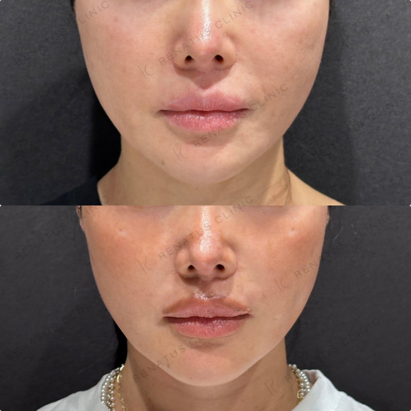 頬ヒアルロン酸ボライト症例写真