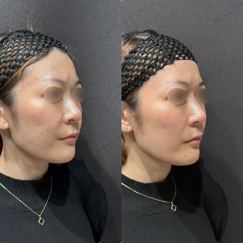 頬ヒアルロン酸ボリフト症例写真