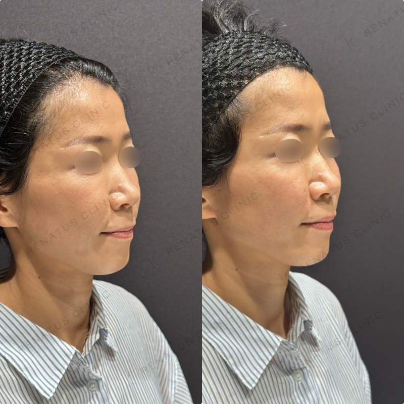 頬ヒアルロン酸ボリフト症例写真