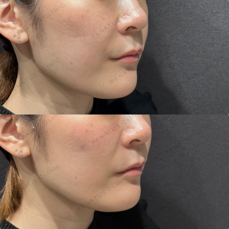 頬ヒアルロン酸ボリフト症例写真