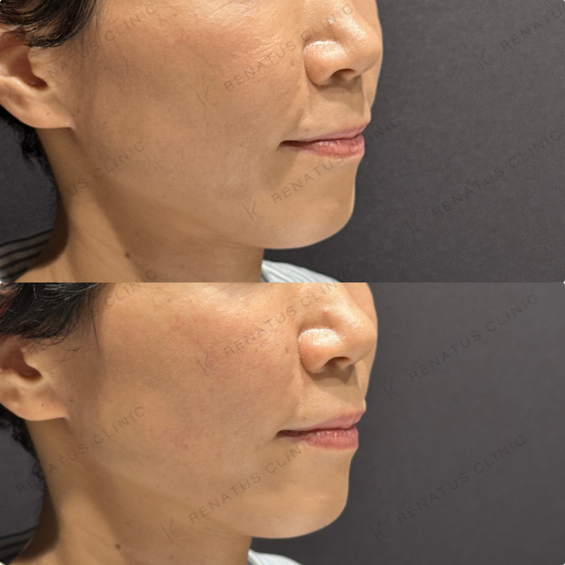 頬ヒアルロン酸ボリフト症例写真