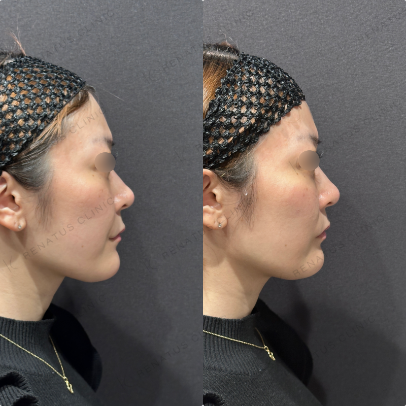 頬ヒアルロン酸ボリフト症例写真