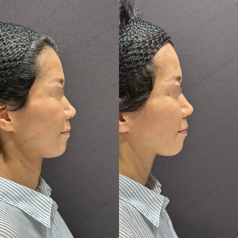 頬ヒアルロン酸ボリフト症例写真