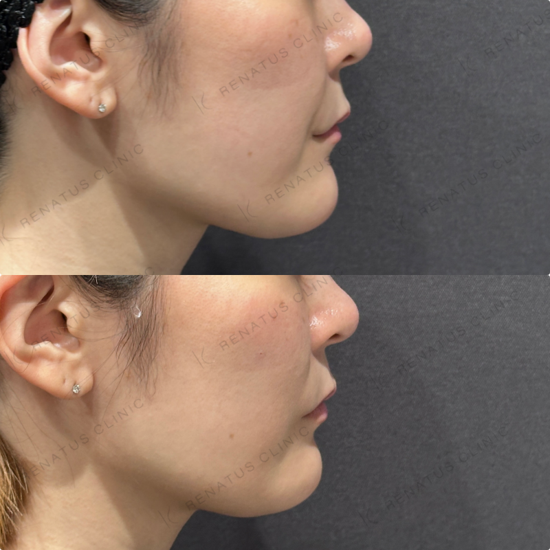 頬ヒアルロン酸ボリフト症例写真