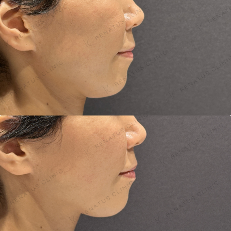 頬ヒアルロン酸ボリフト症例写真