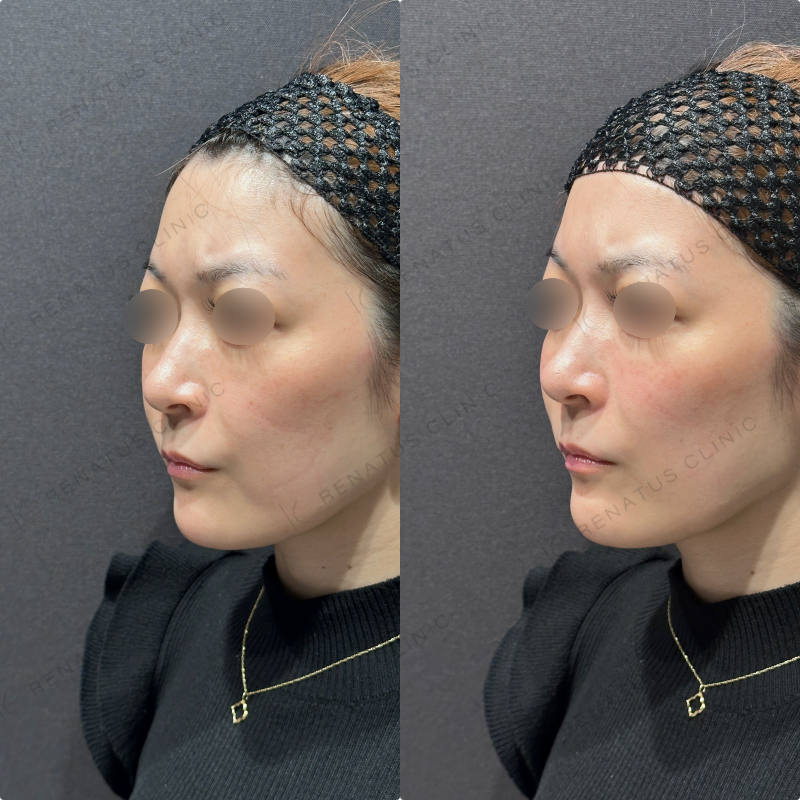 頬ヒアルロン酸ボリフト症例写真