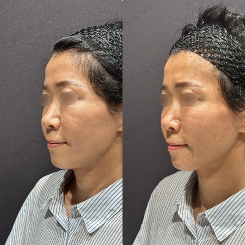 頬ヒアルロン酸ボリフト症例写真