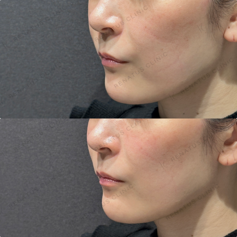 頬ヒアルロン酸ボリフト症例写真