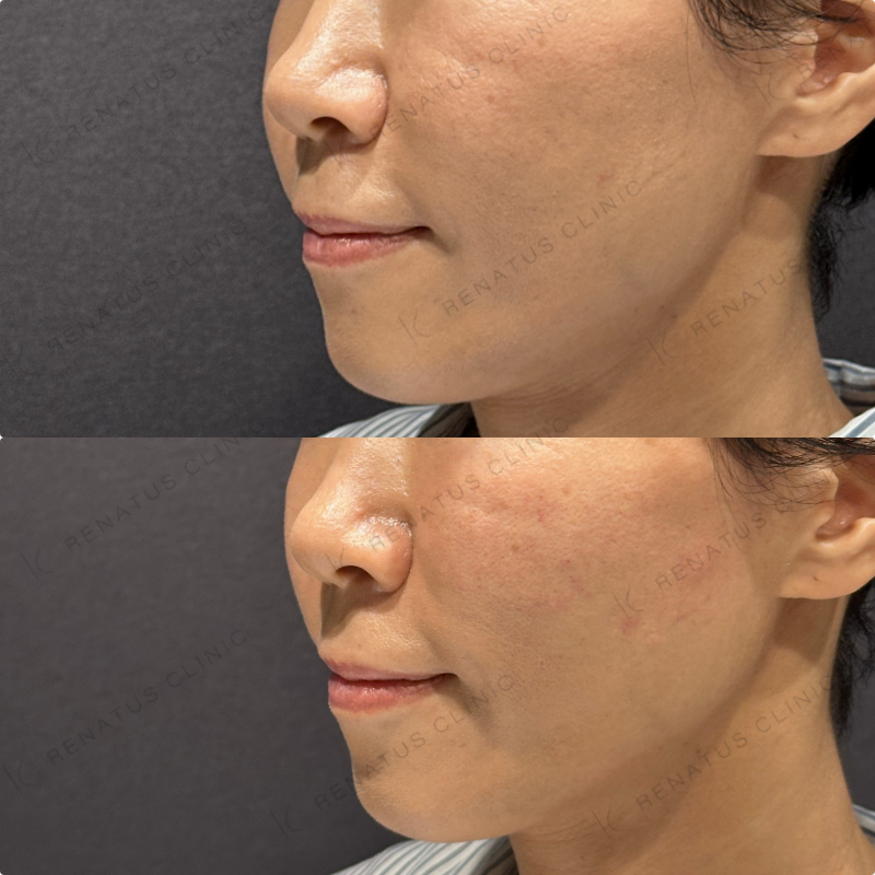 頬ヒアルロン酸ボリフト症例写真