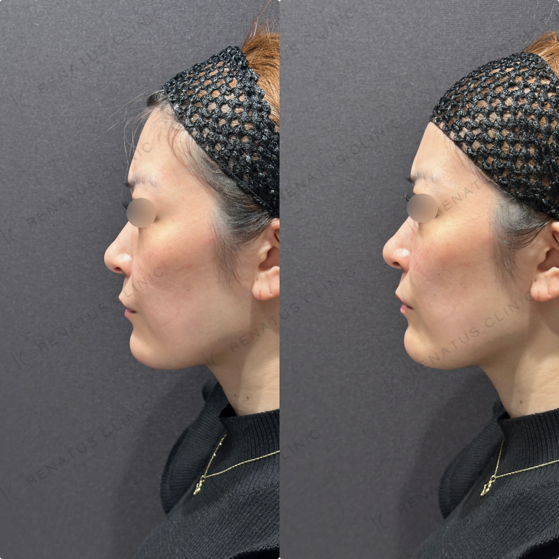 頬ヒアルロン酸ボリフト症例写真