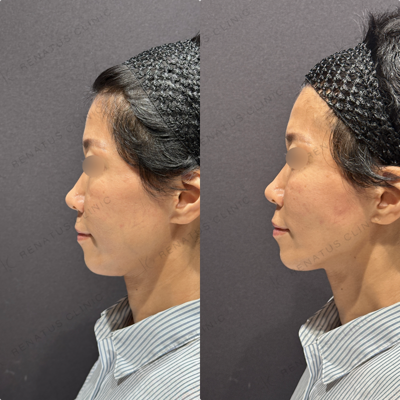 頬ヒアルロン酸ボリフト症例写真