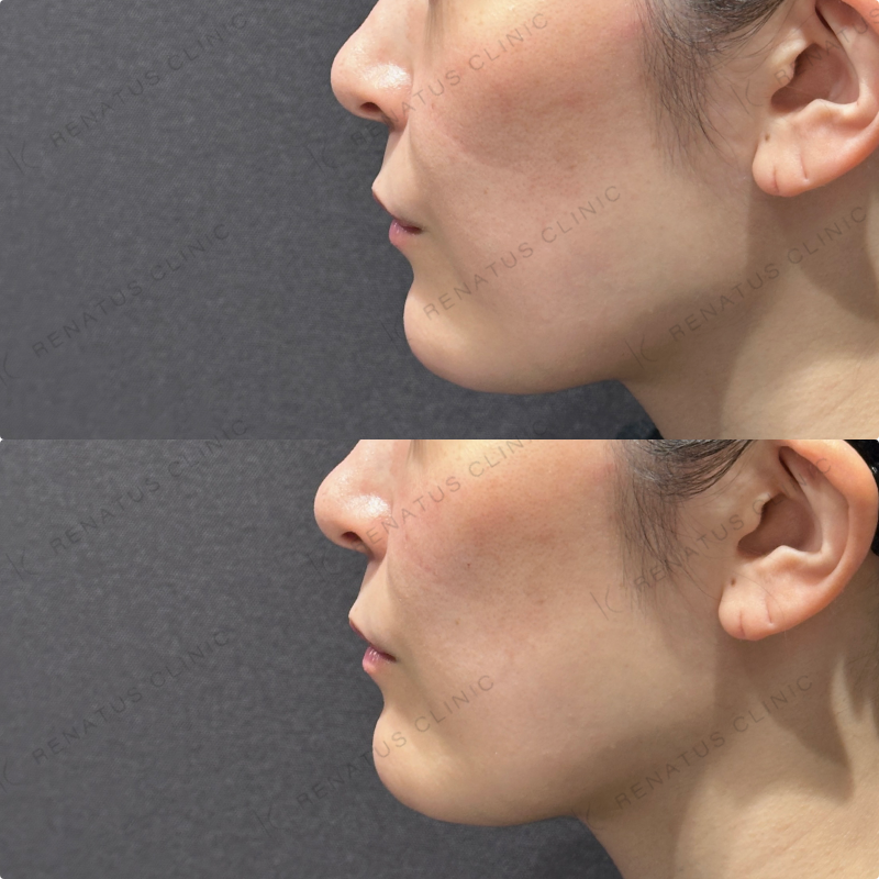 頬ヒアルロン酸ボリフト症例写真