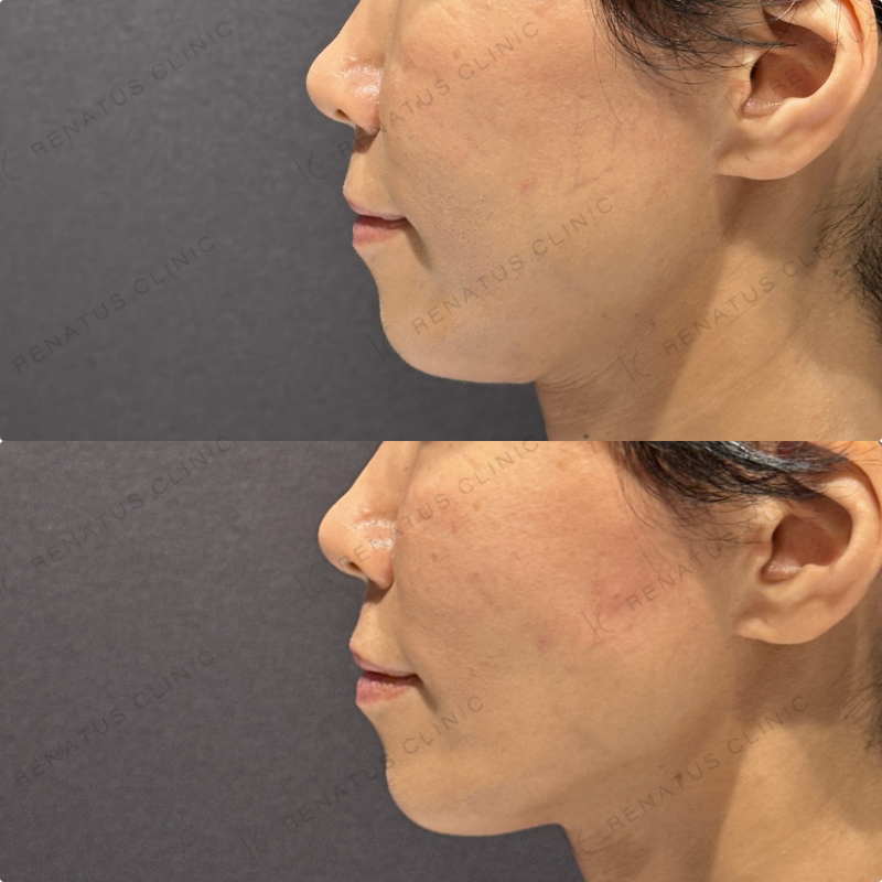 頬ヒアルロン酸ボリフト症例写真