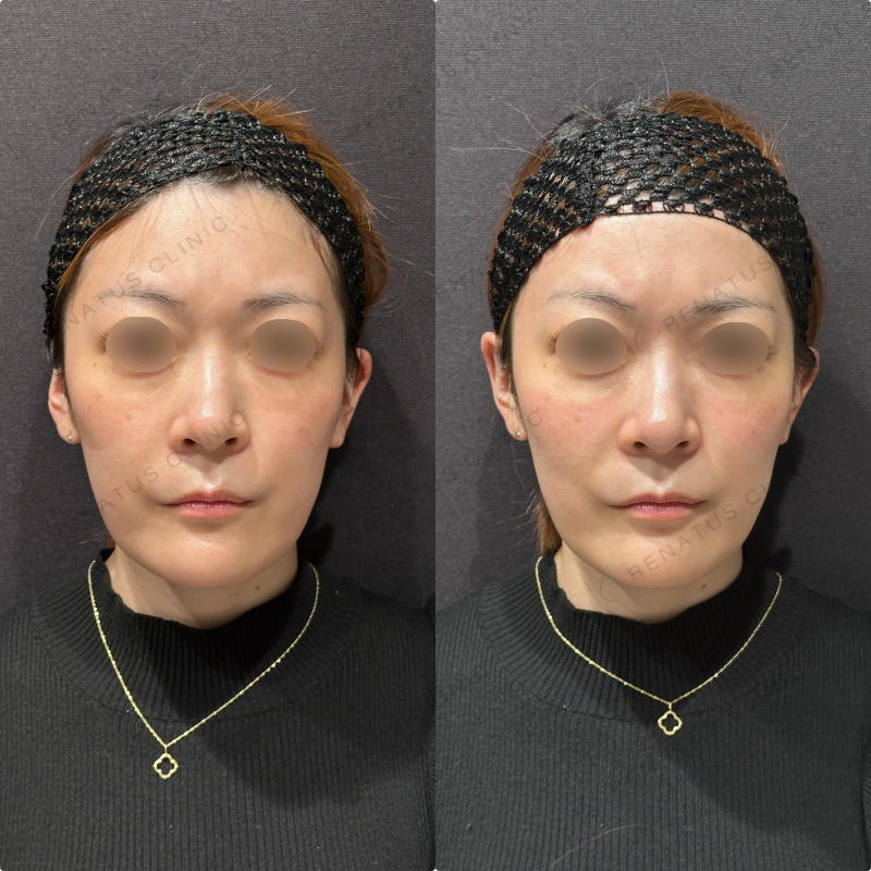 頬ヒアルロン酸ボリフト症例写真