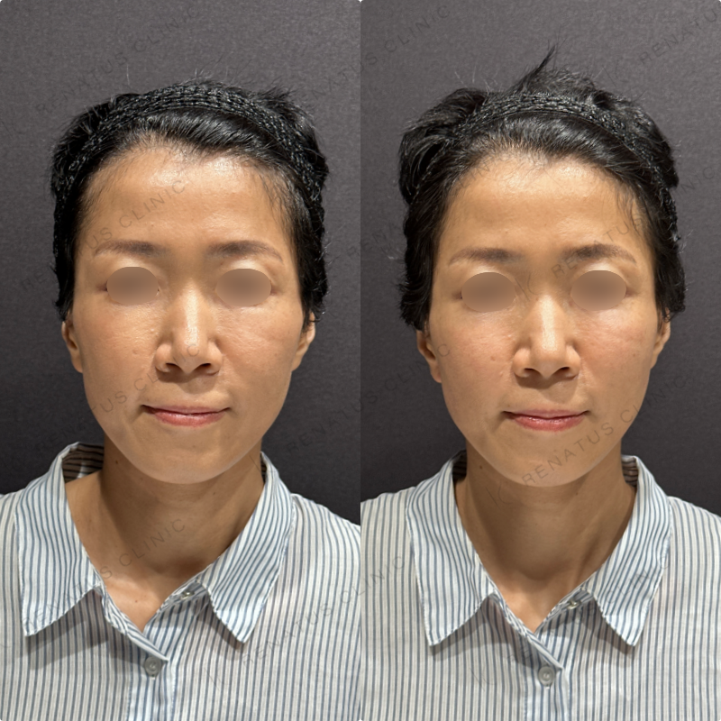 頬ヒアルロン酸ボリフト症例写真
