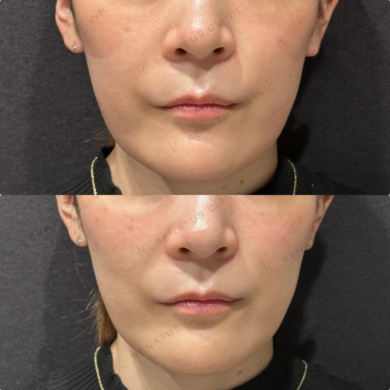頬ヒアルロン酸ボリフト症例写真