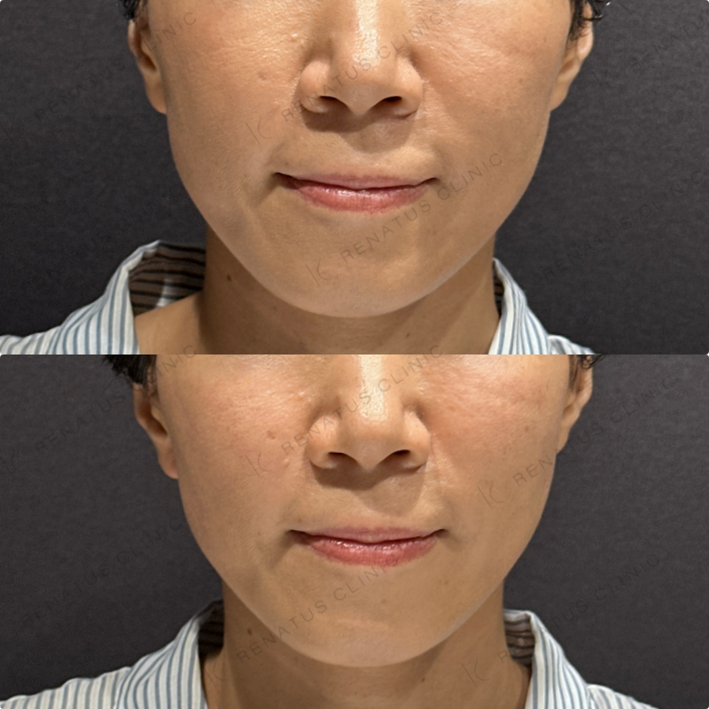 頬ヒアルロン酸ボリフト症例写真