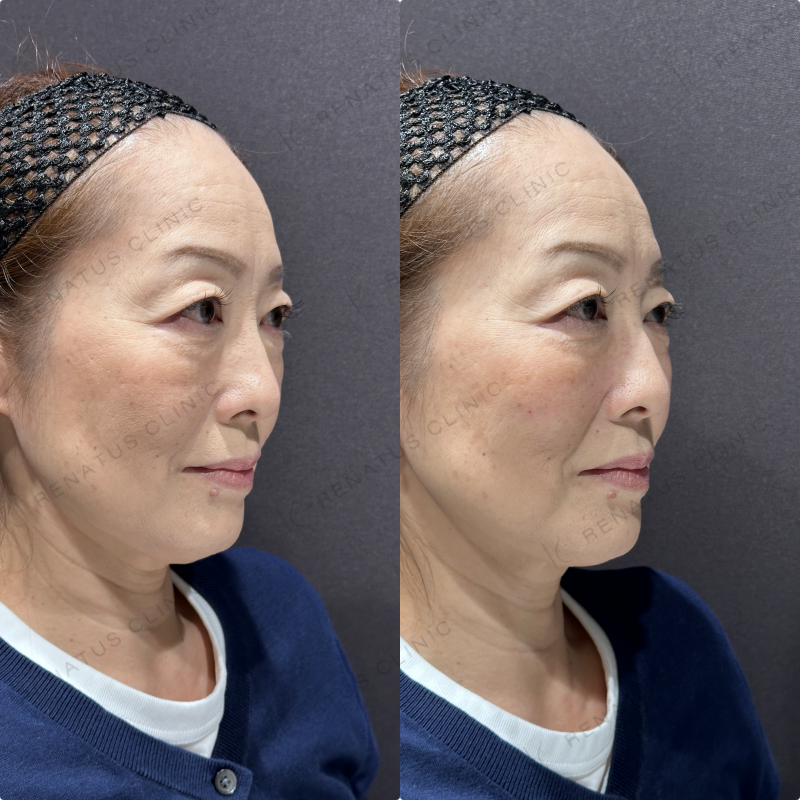 頬ヒアルロン酸ボリューマ症例写真