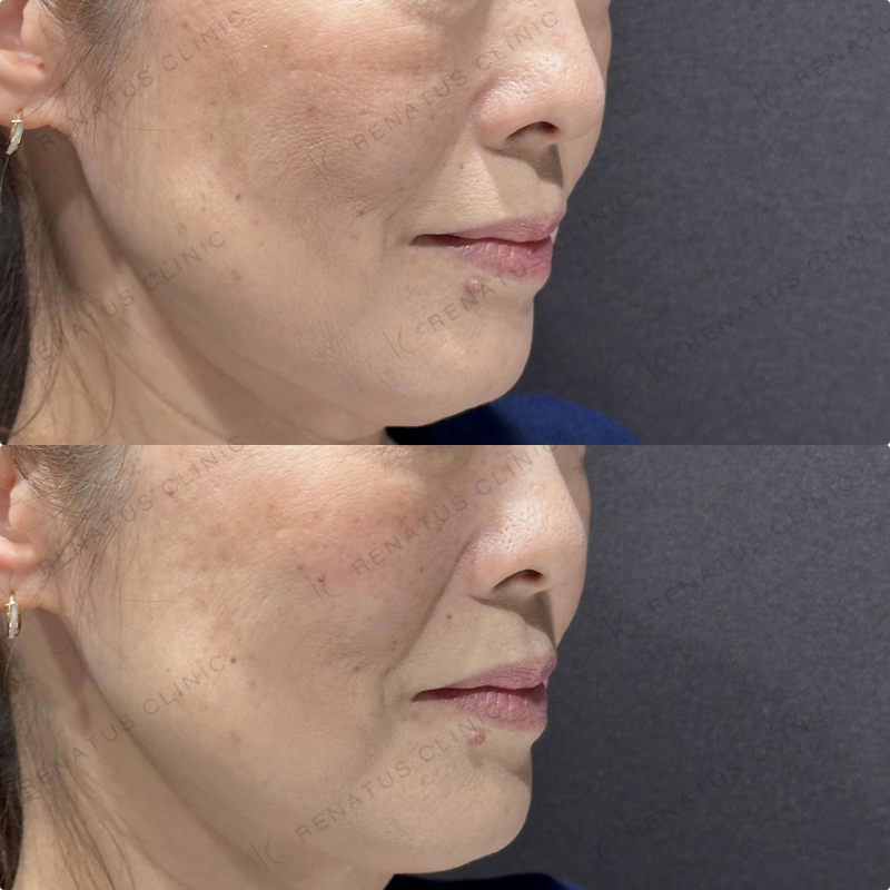 頬ヒアルロン酸ボリューマ症例写真