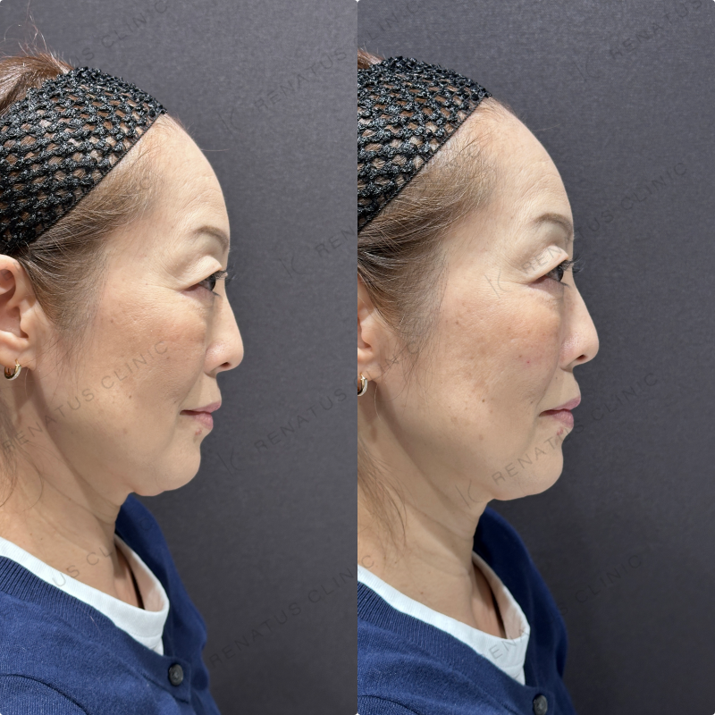 頬ヒアルロン酸ボリューマ症例写真