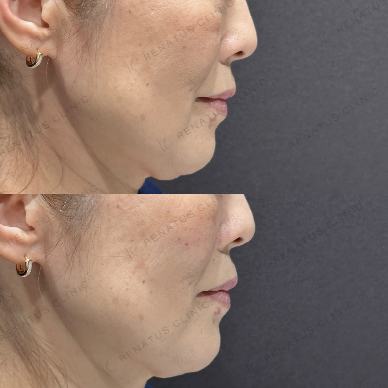 頬ヒアルロン酸ボリューマ症例写真