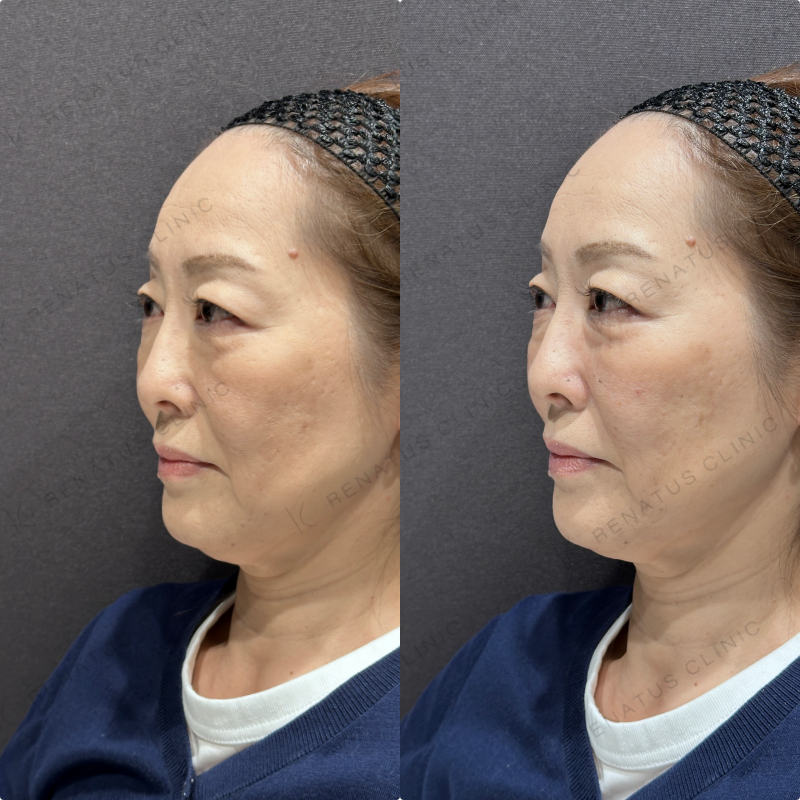 頬ヒアルロン酸ボリューマ症例写真