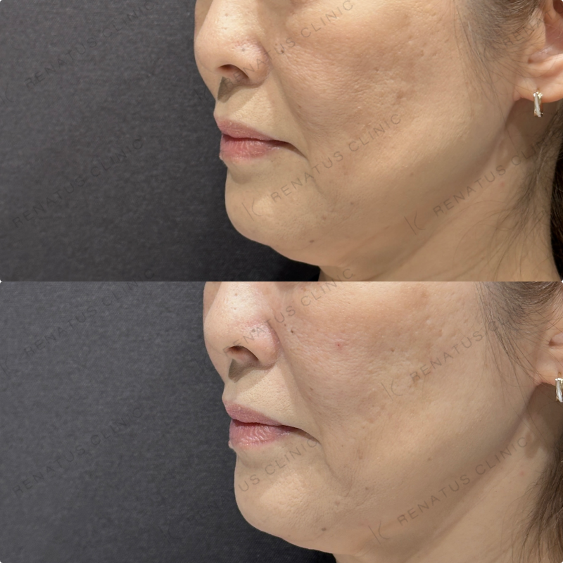 頬ヒアルロン酸ボリューマ症例写真