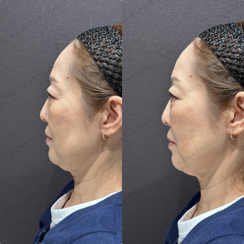 頬ヒアルロン酸ボリューマ症例写真