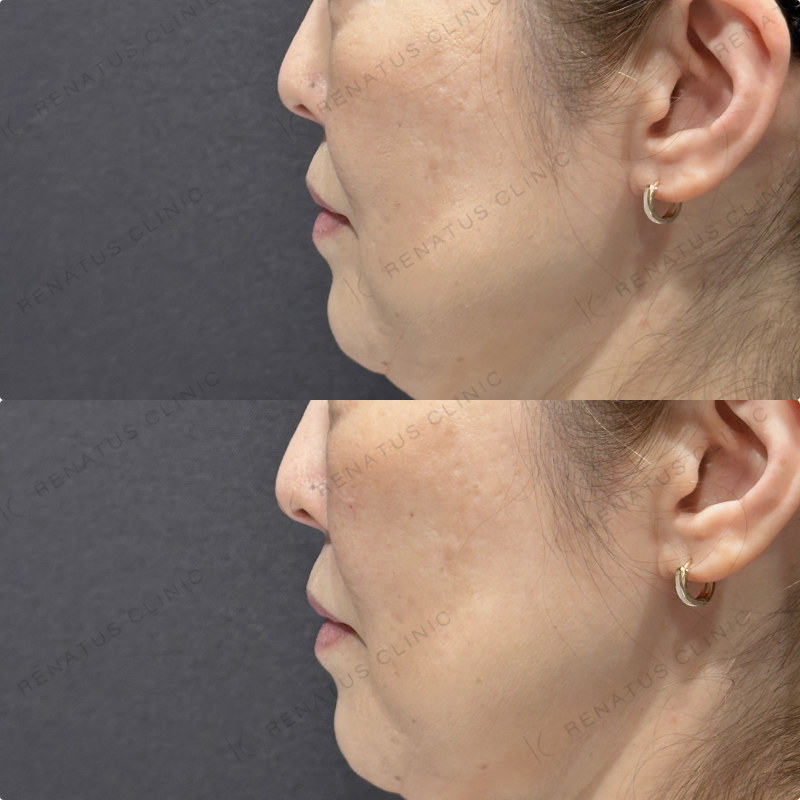 頬ヒアルロン酸ボリューマ症例写真