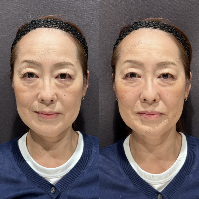 頬ヒアルロン酸ボリューマ症例写真