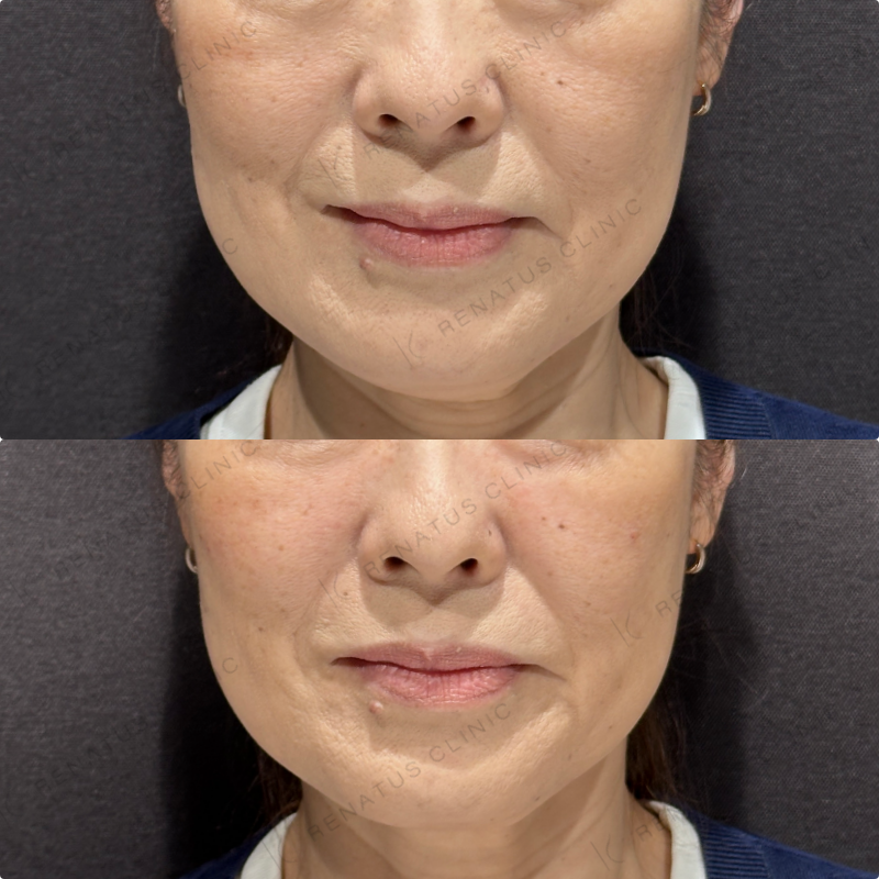 頬ヒアルロン酸ボリューマ症例写真