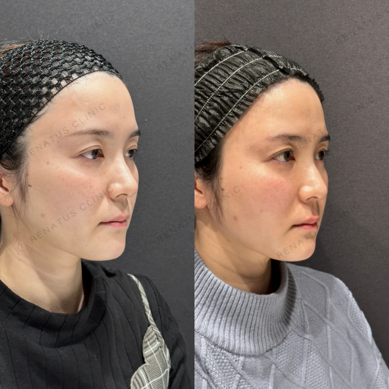 頬こけヒアルロン酸ボライト症例写真