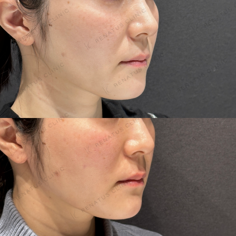 頬こけヒアルロン酸ボライト症例写真