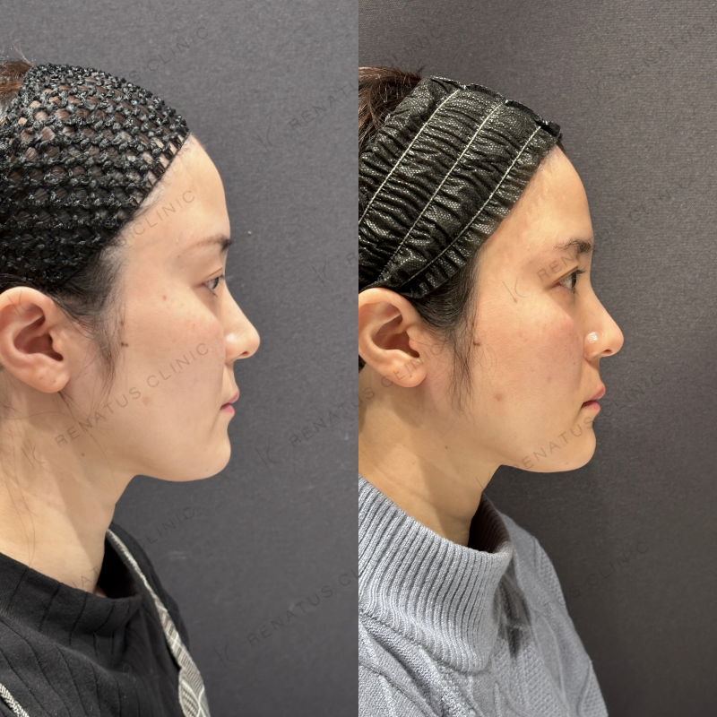 頬こけヒアルロン酸ボライト症例写真