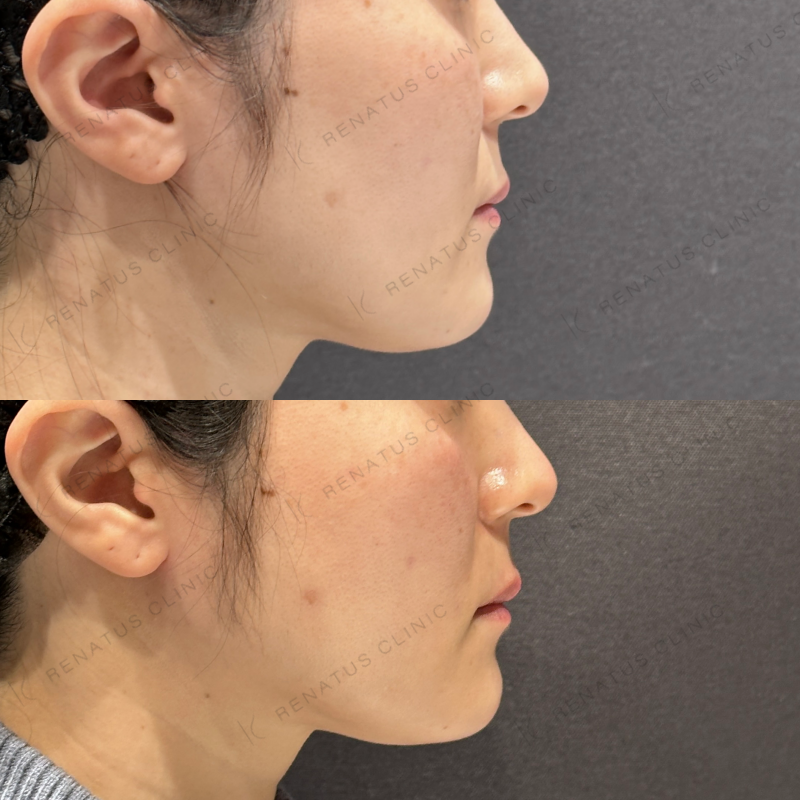 頬こけヒアルロン酸ボライト症例写真