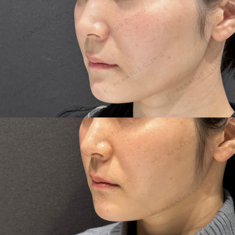 頬こけヒアルロン酸ボライト症例写真