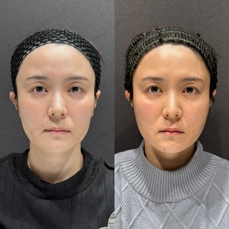 頬こけヒアルロン酸ボライト症例写真