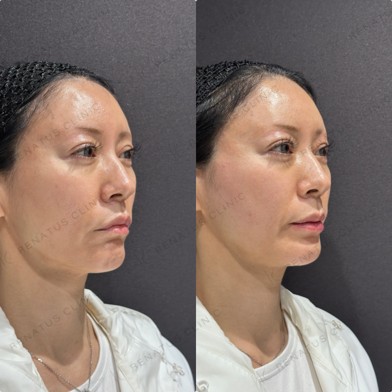 頬コケ・下唇ヒアルロン酸ボリフト・ボルベラ症例写真