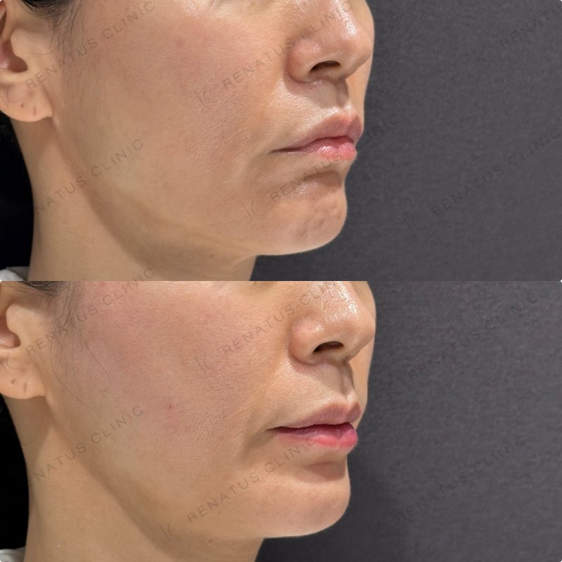 頬コケ・下唇ヒアルロン酸ボリフト・ボルベラ症例写真