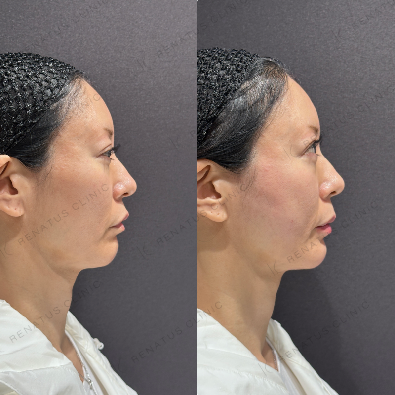 頬コケ・下唇ヒアルロン酸ボリフト・ボルベラ症例写真