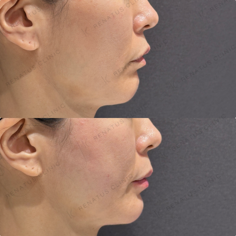 頬コケ・下唇ヒアルロン酸ボリフト・ボルベラ症例写真