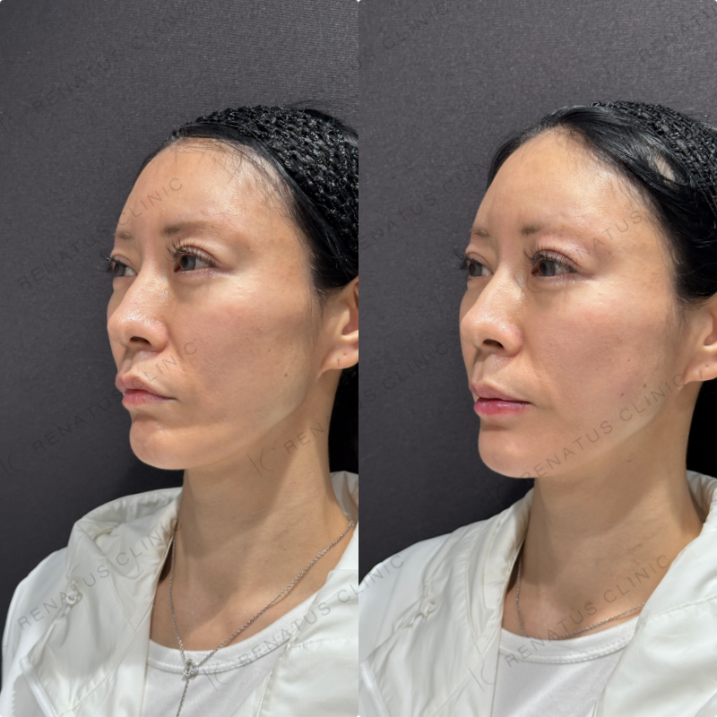 頬コケ・下唇ヒアルロン酸ボリフト・ボルベラ症例写真