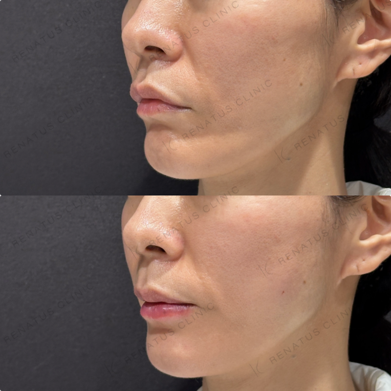 頬コケ・下唇ヒアルロン酸ボリフト・ボルベラ症例写真