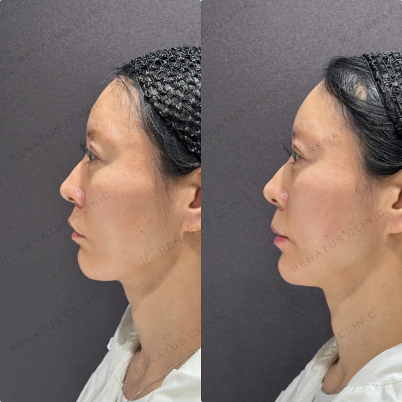 頬コケ・下唇ヒアルロン酸ボリフト・ボルベラ症例写真