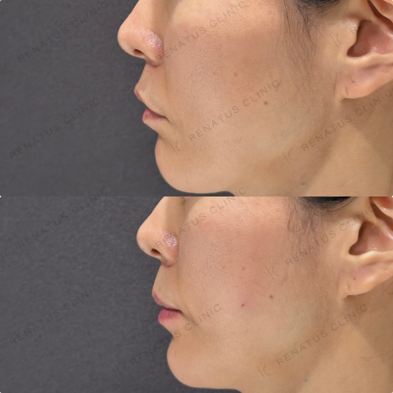 頬コケ・下唇ヒアルロン酸ボリフト・ボルベラ症例写真