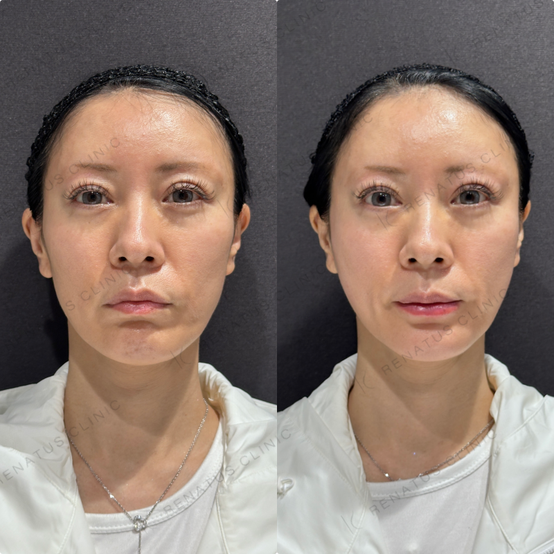 頬コケ・下唇ヒアルロン酸ボリフト・ボルベラ症例写真