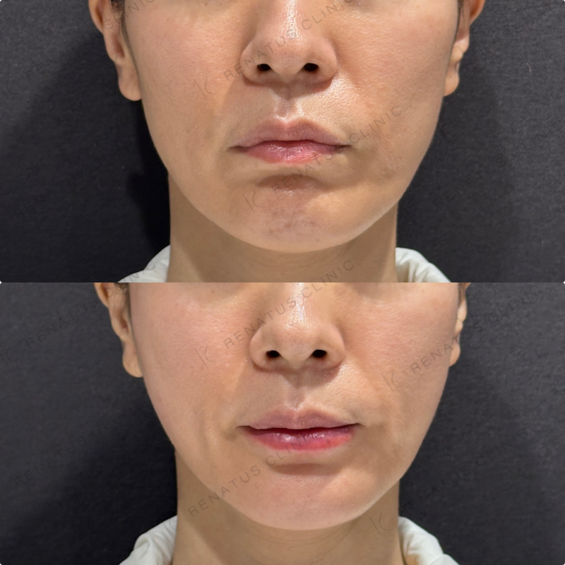 頬コケ・下唇ヒアルロン酸ボリフト・ボルベラ症例写真