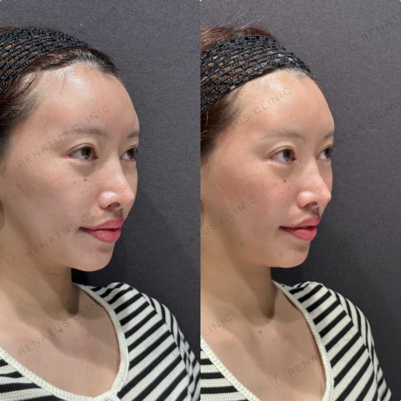 頬コケ・頬ヒアルロン酸ボリフト・ボリューマ症例写真